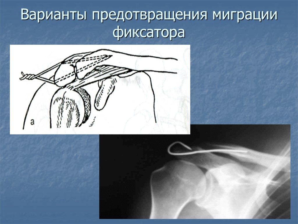 Варианты предотвращения миграции фиксатора